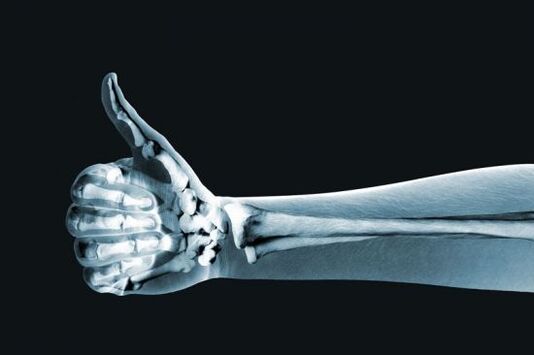 Radiographie pour diagnostiquer la douleur dans les articulations des doigts. 