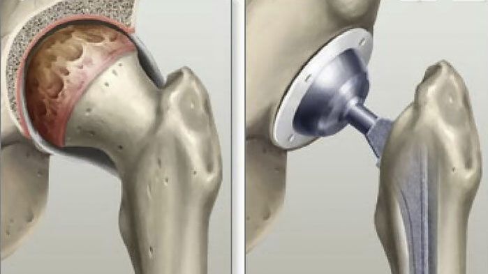 Arthroplastie de la hanche réalisée aux stades finaux de la coxarthrose. 