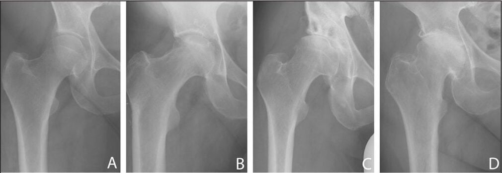 Stades de développement de l'arthrose de l'articulation de la hanche sur une radiographie. 