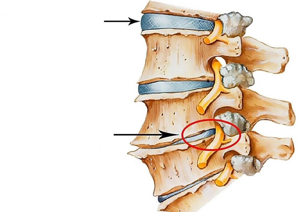 Illustration de disques vertébraux sains et déformés.