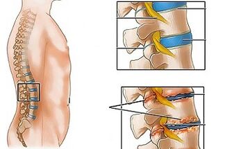 Les causes de l'ostéochondrose lombaire