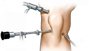 arthroscopie pour l'arthrose de l'articulation du genou