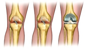 endoprothèse pour l'arthrose de l'articulation du genou